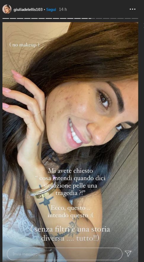de lellis acne