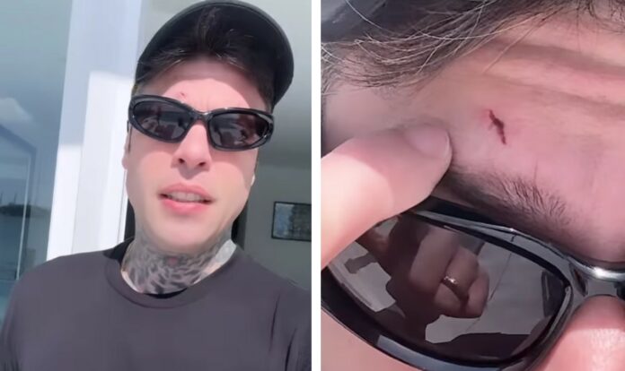 Fedez da solo a Miami senza Chiara Ferragni e i figli: il rapper ha avuto un piccolo incidente