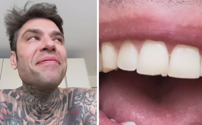 Le sfighe di Fedez continuano: il rapper mostra il danno al dente dopo l'allenamento