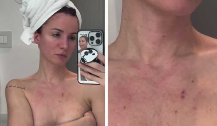 ''Mi sono dimenticata totalmente di collo e petto'': Andrea Delogu mostra i segni del tempo sulla pelle per non aver messo la crema solare
