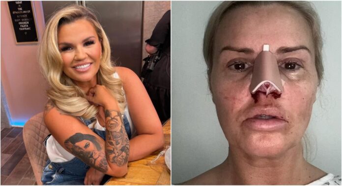 Kerry Katona delle Atomic Kitten mostra i danni dall’abuso di cocaina: “Ho un buco nel naso”