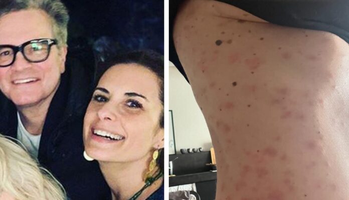 ''Sono letteralmente in fiamme, coperta da bolle a causa dello stress'': Livia Giuggioli, ex moglie italiana di Colin Firth, mostra foto forti